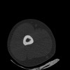 SPORK, NICO - 22.03.1976 - 02.08.2022 - CT obere Extremität - 17:51:17